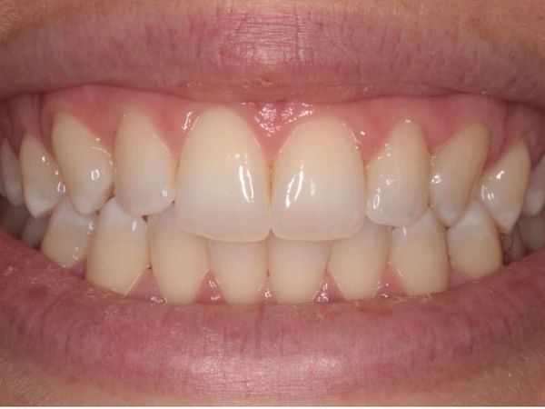 Before teeth whitening treatment
